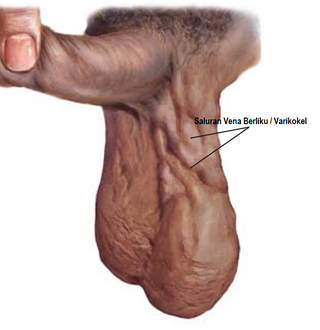 Illustration for article titled Obat Varikokel Alami